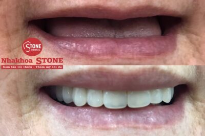 Kết quả phục hình tháo lắp toàn hàm cho người lớn tuổi tại Nha khoa Stone
