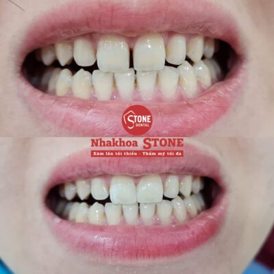 Hình ảnh trước và sau khi đóng khít nhiều kẽ răng thưa bằng Composite tại Nha khoa Stone